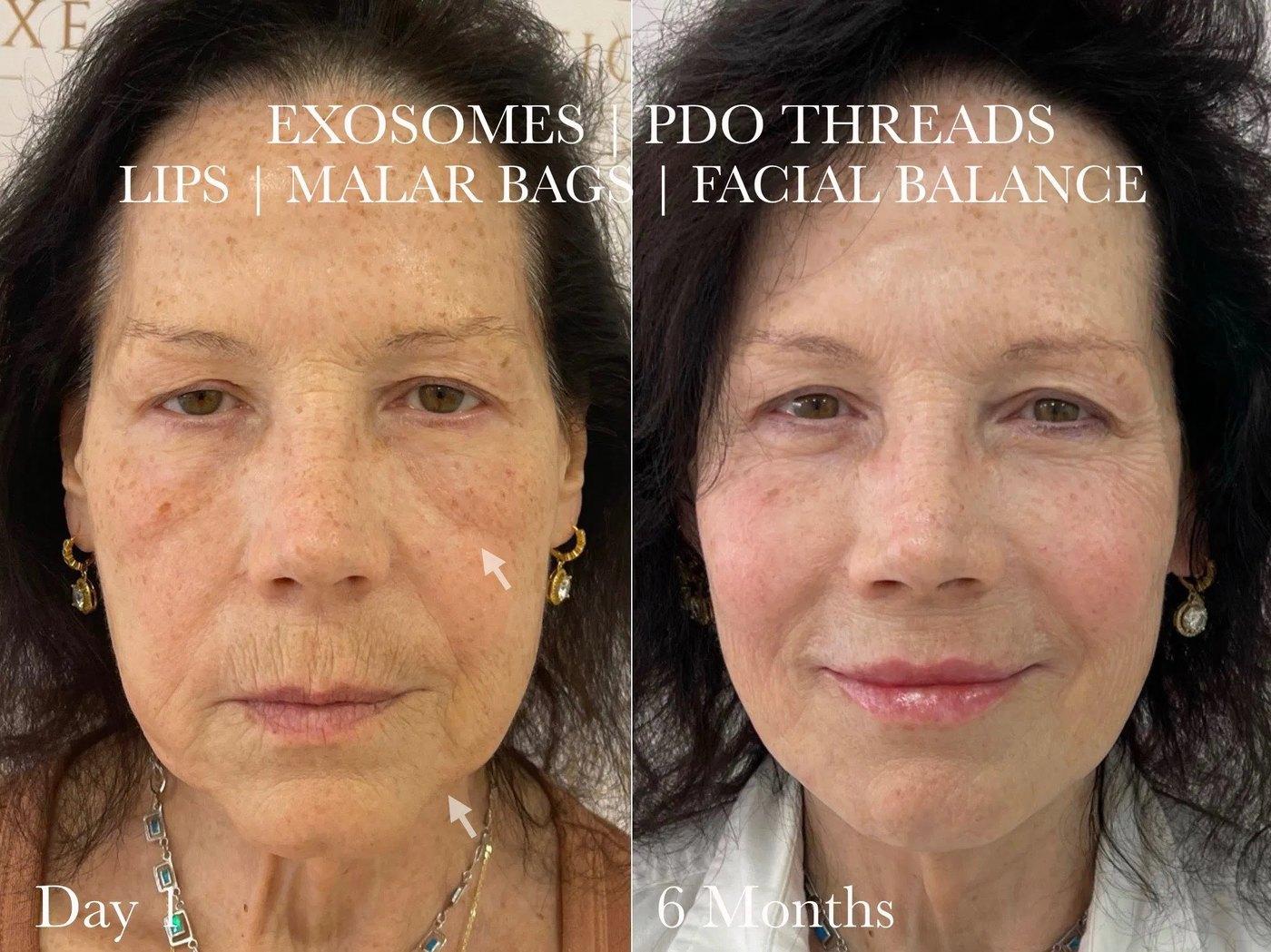Before and after a course of exosomes, PDO threads and facial balancing at Aesthetics Deluxe, shown at day one and six months