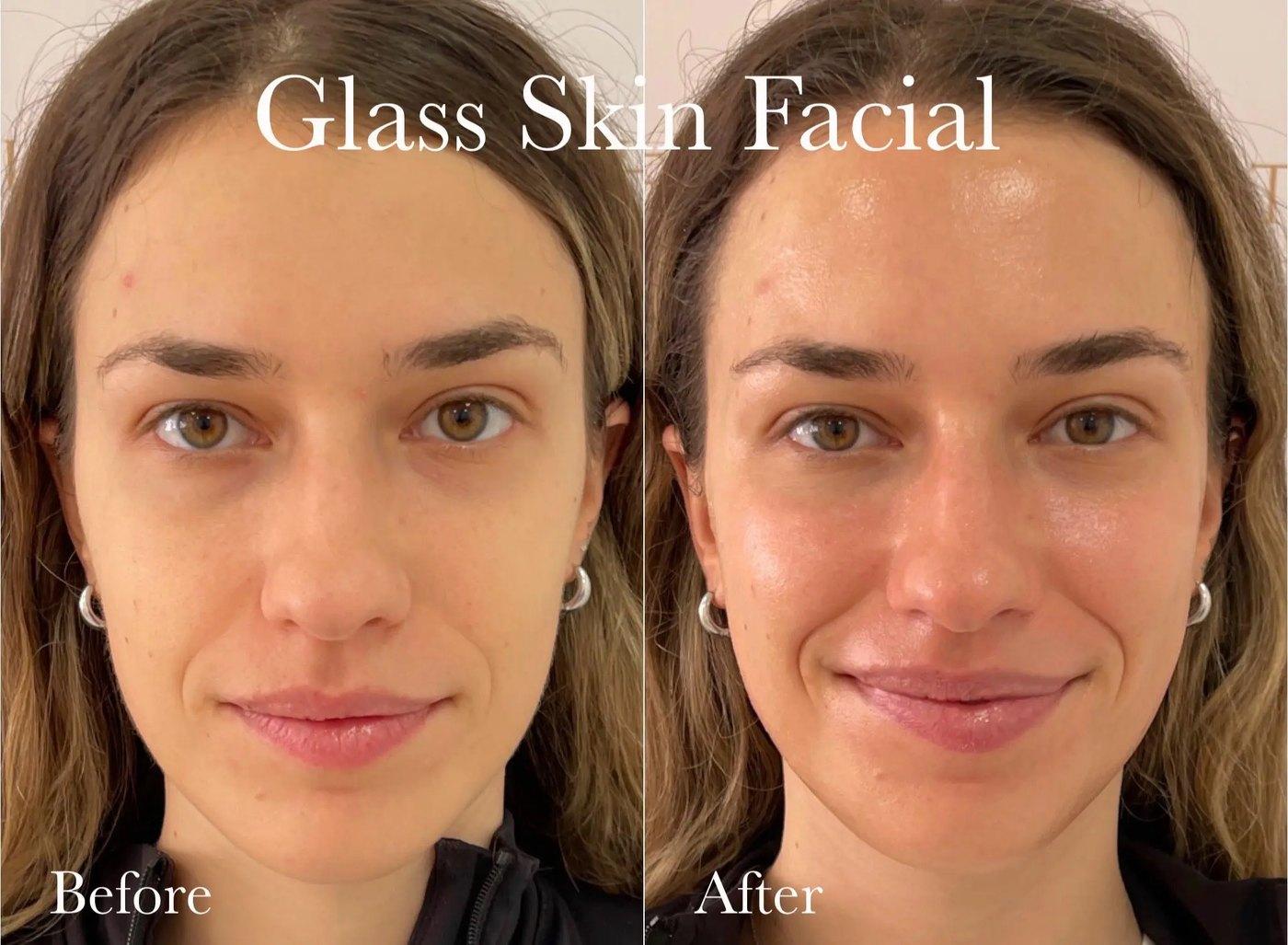 Before and after a Glass Skin Facial at Aesthetics Deluxe