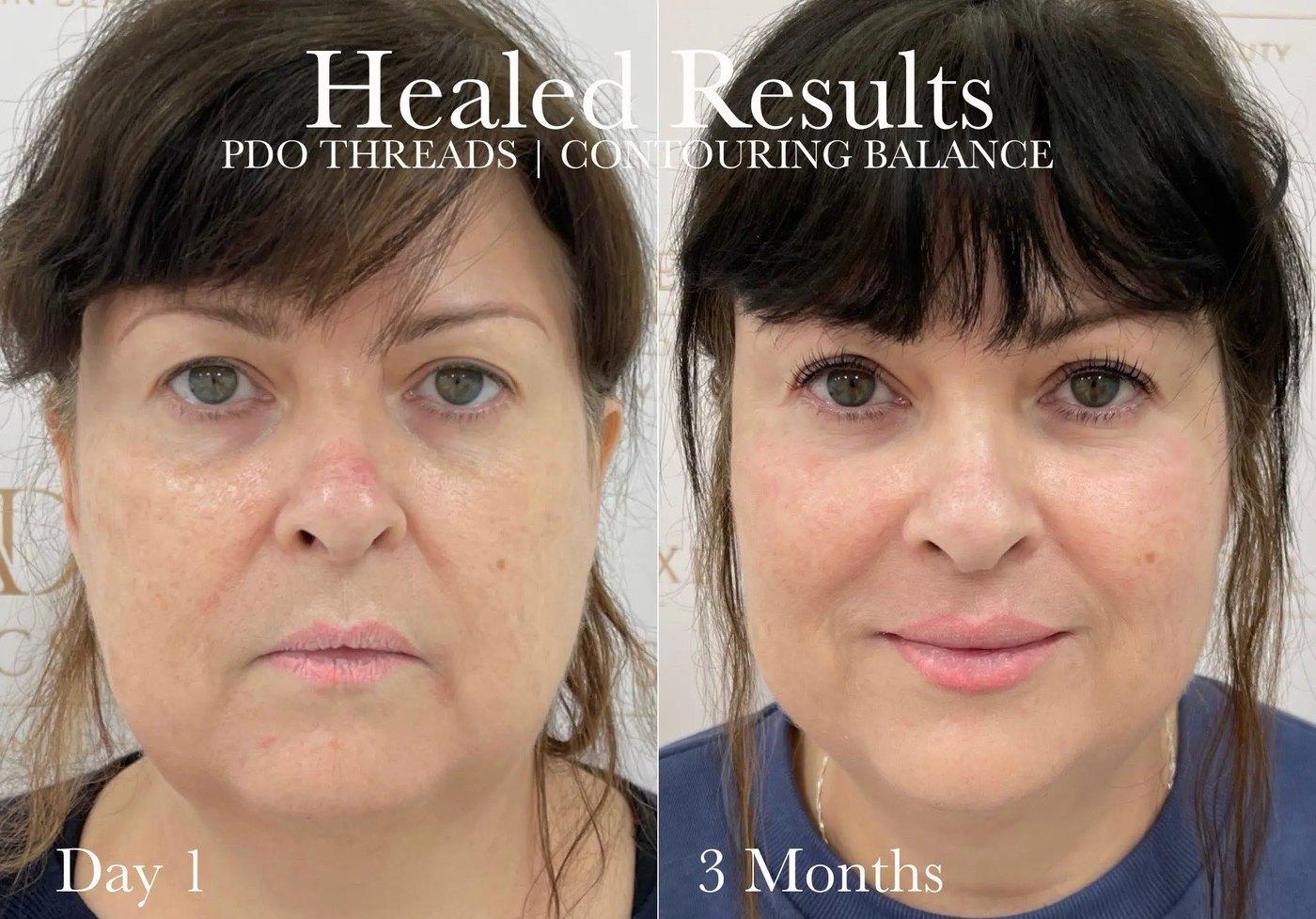 Before and after PDO threads and contouring at Aesthetics Deluxe, shown at day one and three months